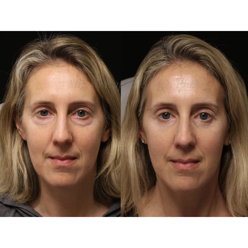 Customer before-and-after eye-care result